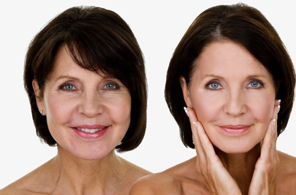 Hilger-Facelift_facial plastic surgery Minneapolis and Edina